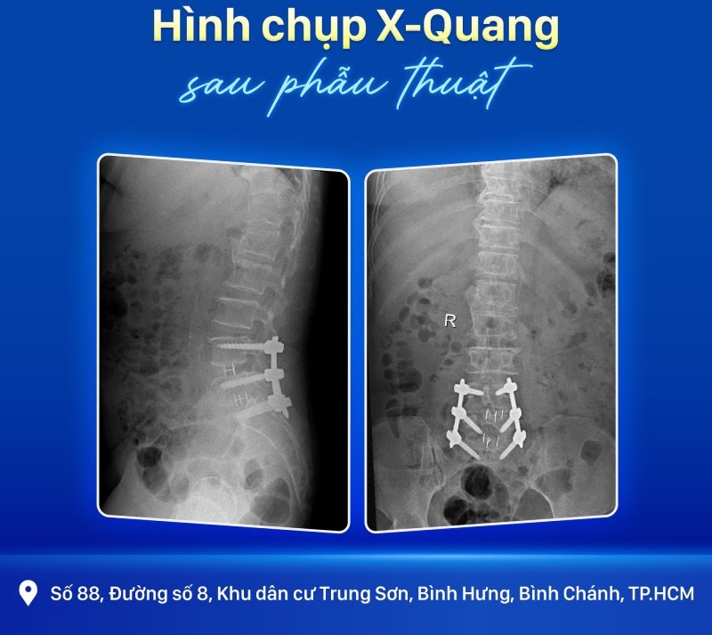 dieu-tri-thoat-vi-dia-dem-voi-he-thong-o-arm-va-cong-nghe-dinh-vi-3d-sau-phau-thuat